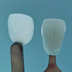 World’s Thinnest 3D Printed Cosmetic Dental Veneer Unveiled