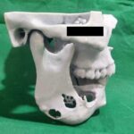 Filipino Expat Gets 3D Printed Jaw in Dubai