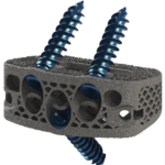 DeGen Medical Reveals 3D Printed ALIF Implant